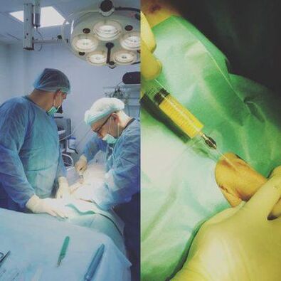Förtjockning av penis är möjlig med hjälp av kirurgi