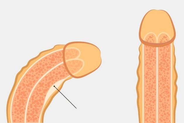 effektivt sätt att räta ut penis