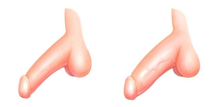 penis före och efter förstoring